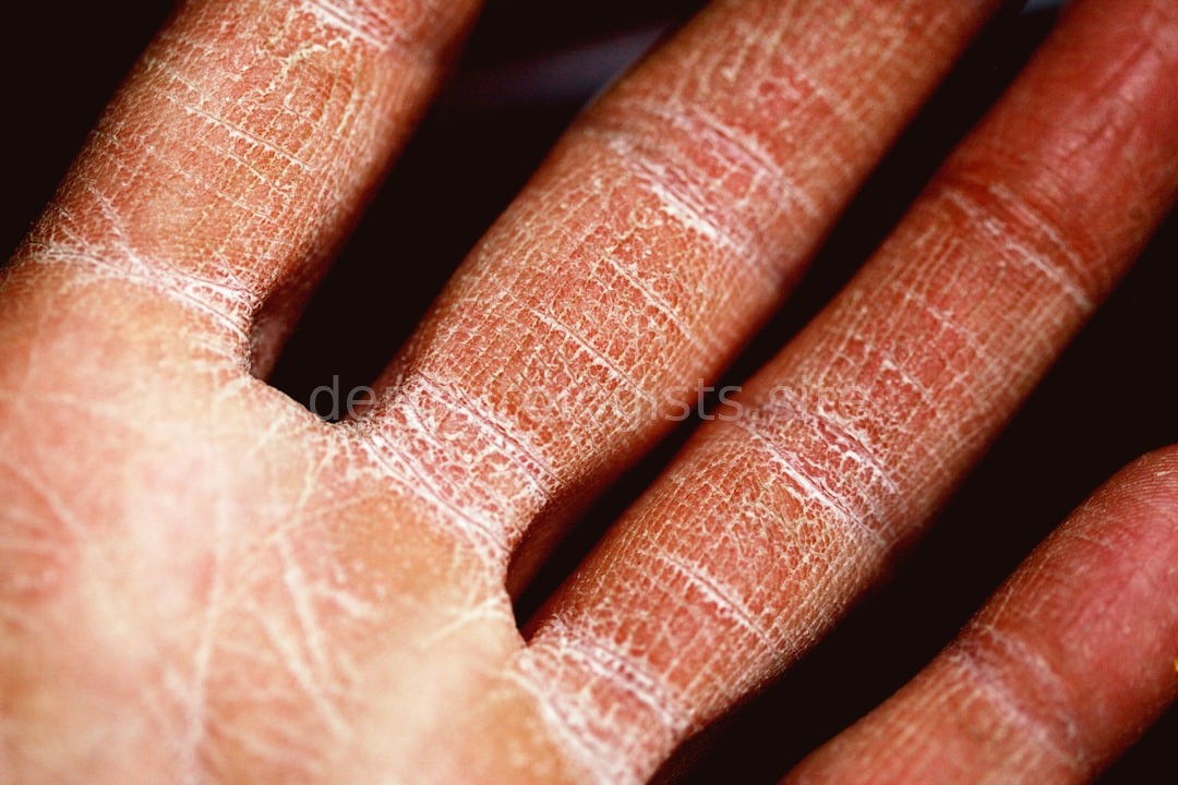 Dermatology Hero